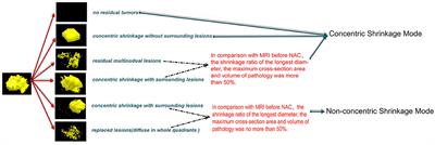 Mutant Allele Frequency-Based Intra-Tumoral Genetic Heterogeneity Related to the <mark class="highlighted">Tumor Shrinkage</mark> Mode After Neoadjuvant Chemotherapy in Breast Cancer Patients